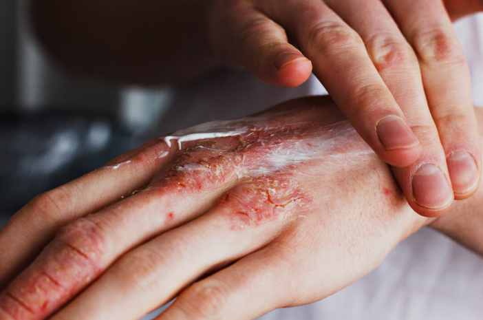 皮膚疾患を治療するための湿疹軟膏の種類