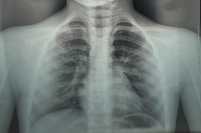 إجراء تصوير الصدر بالأشعة السينية للكشف عن قصور القلب الاحتقاني