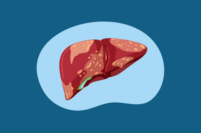 Cos'è la malattia del fegato grasso?