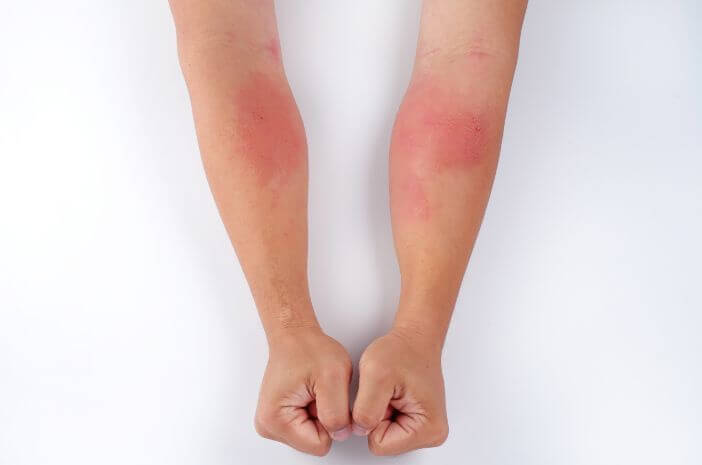 Queste 4 malattie della pelle sono scatenate dai virus