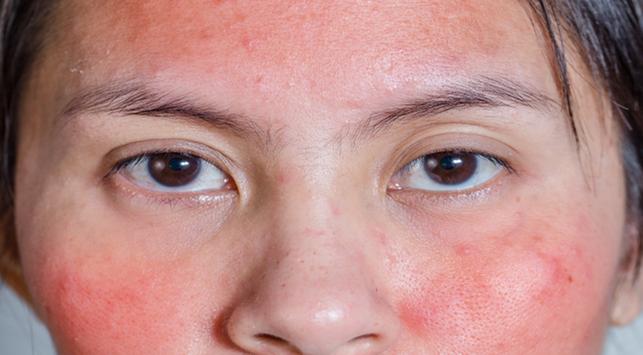 Появява се обрив или подуване, разпознайте характеристиките на козметична алергия