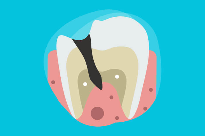 Tartar Dişleri Gerçekten Gözenekli Yapabilir mi?