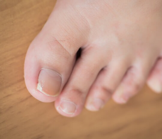 Hati-hati, memotong kuku dengan sewenang-wenangnya boleh menyebabkan kuku kaki tumbuh ke dalam