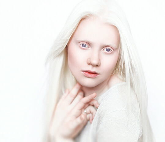 Bukan kerana perkahwinan campur, berikut adalah 5 fakta mengenai albinisme