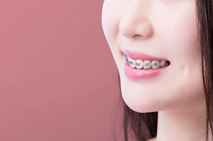 4 طرق لمنع مرض القلاع لمن يرتدون تقويم الأسنان