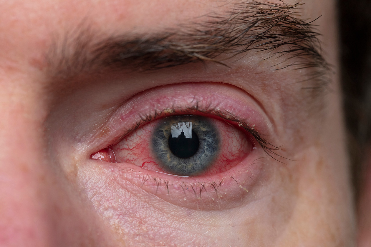 التهاب الملتحمة الفيروسي ، ما هو مرض العين؟