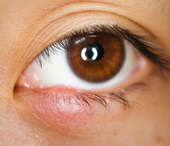 Adakah benar bahawa stye dapat disebarkan melalui kontak mata?