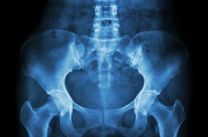 Questa è una procedura di scansione ossea per rilevare le fratture dell'anca