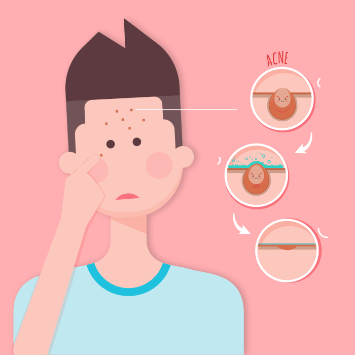 Conoscere 5 fatti sull'acne