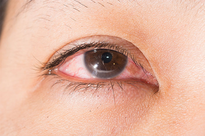 Какво се случва с очите ви, когато имате кератит?