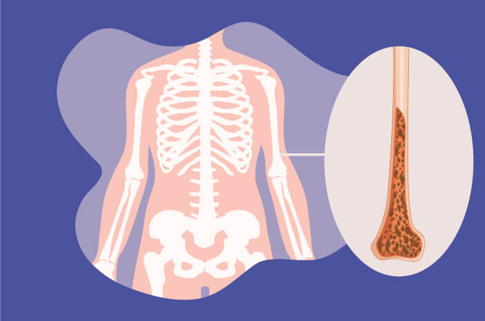 Има много видове, познайте тези 4 вида остеопороза
