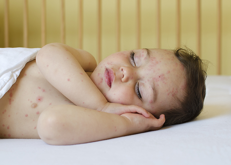 เด็กที่เป็นโรคหัด สามารถนอนในห้องแอร์ได้หรือไม่?