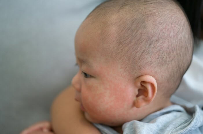 Bebeklerde Ani Döküntü, Atopik Dermatite Dikkat Edin