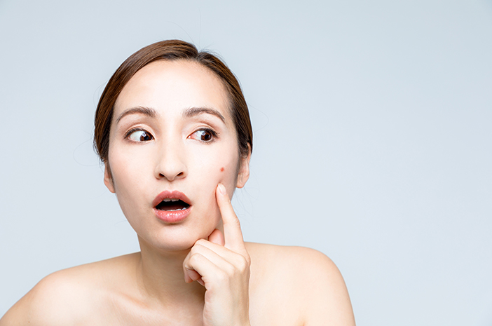 Miti sull'acne che devono essere raddrizzati